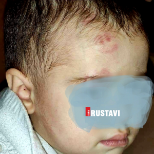 "დედიკო, შენი შვილი დაკბინეს" [photo]